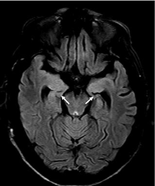 Case Report: Anti-LGI1 Limbic Encephalitis Associated With Anti-thyroid Autoantibodies